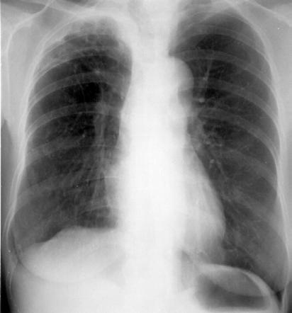 Target: Risk of Progression TB4: Individuals with abnormal CXR compatible with past (untreated) TB Risk of active disease is 10x that of a person with a normal x-ray and no other risk factors Higher