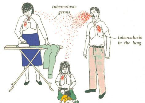 Stages of Tuberculosis Exposure to Contagious Adult with Pulmonary Disease Household contacts 20-30%