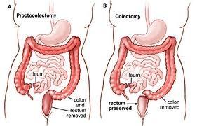 Surgery for Crohn s: Colonic