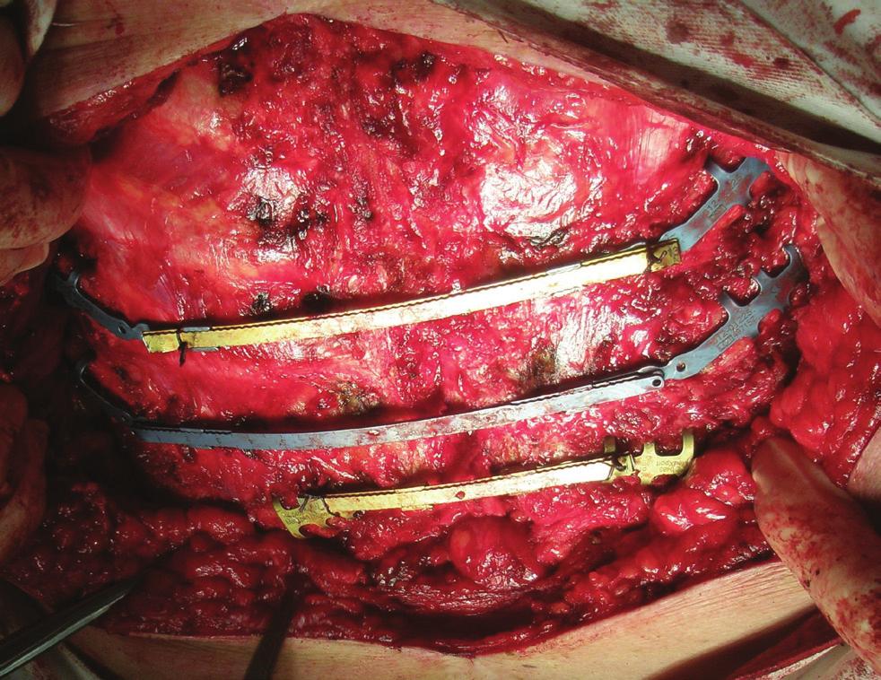 Ištyrus širdį bei vainikines kraujagysles patologijos nekonstatuota. Krūtinės rentgenogramoje buvo matyti, jog viena iš vielų, fiksuojančių krūtinkaulį, yra lūžusi.