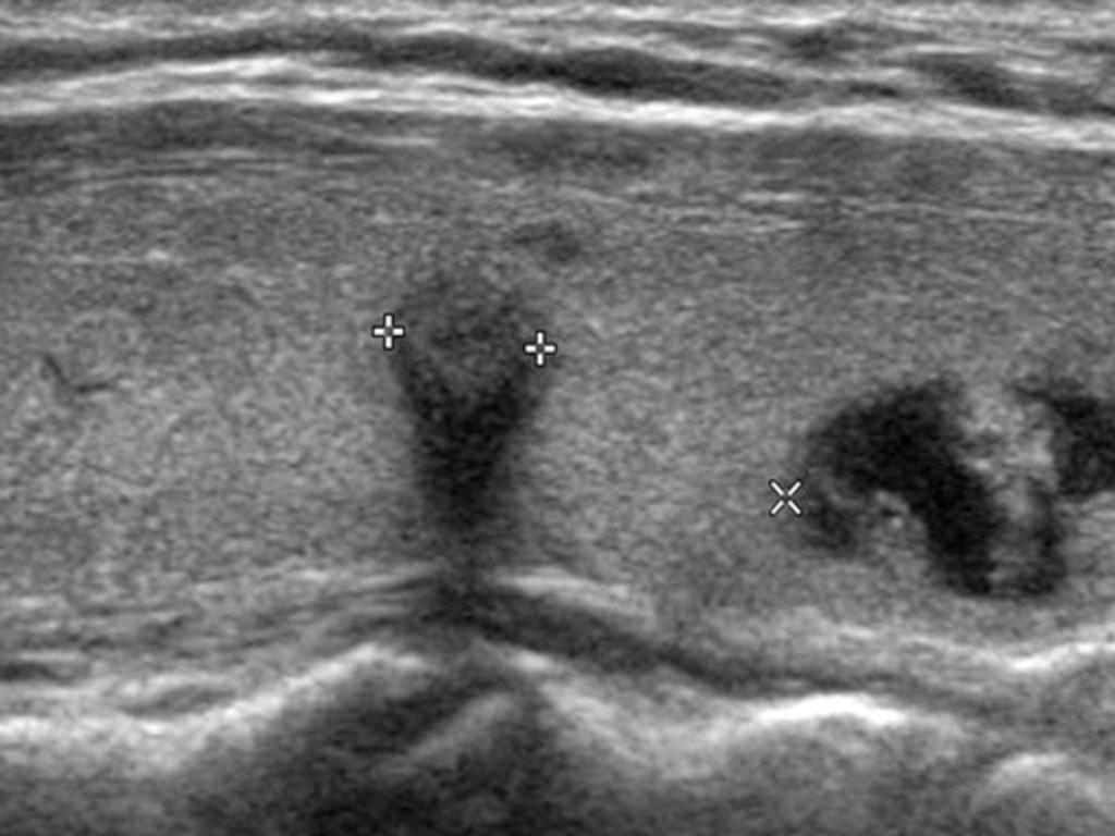 Fig. 4: Diagnostic Index for Individual Sonographic Feature of Malignant and Benign Thyroid Nodules Fig.