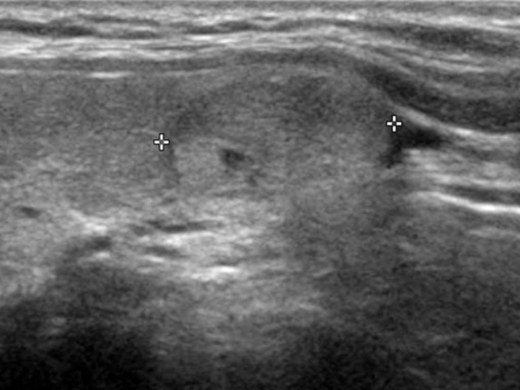 Fig. 6: A papillary thyroid carcinoma assigned as 'suggestive for benign' on thyroid US in an 18-year-old woman (a case of false negative).