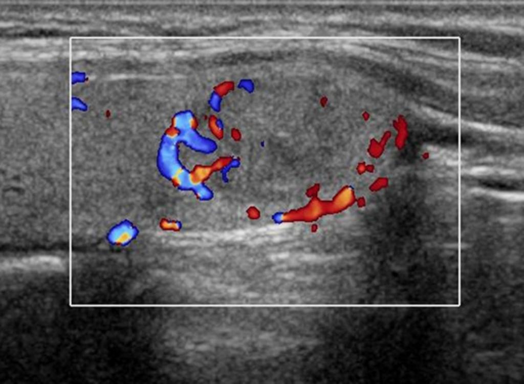 Fig. 7: A papillary thyroid carcinoma assigned as 'suggestive for benign' on thyroid US in an 18-year-old woman (a case of false negative).
