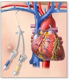 Central Venous Catheter Catheter placed into internal jugular vein,