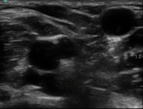 Ultrasound Appearance Artery Round Regular Shape Pulsatile