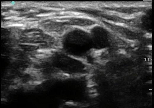 Ultrasound Appearance Short Axis