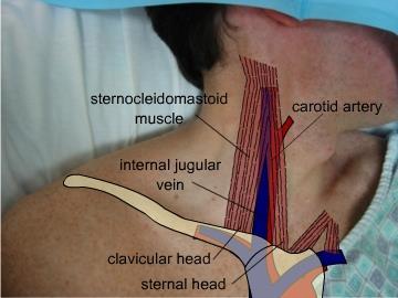 Site Selection Higher in SCM/Clavicle Triangle reduces risk of pneumothorax and allows for better compression if