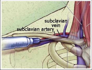 Subclavian Vein Ideal for CVC acces when ultrasound not