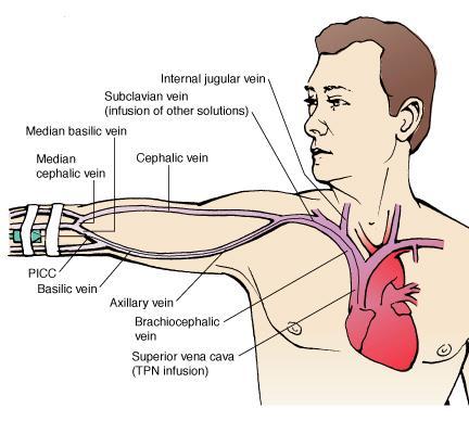 Peripherally Inserted Central Catheter Alternative to subclavian lines, internal jugular lines or femoral lines which have higher