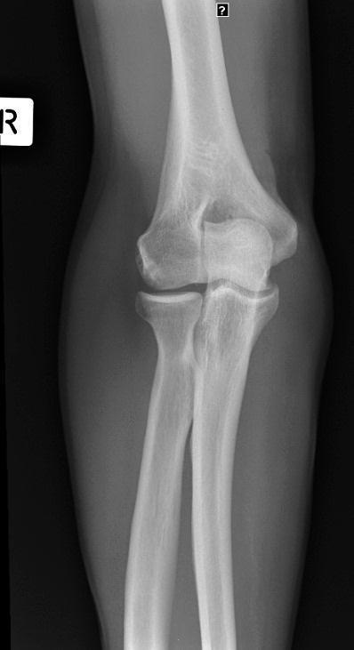 third of radius/ulna Centre Point: Centre on elbow joint 1. Elbow as straight as possible 2.