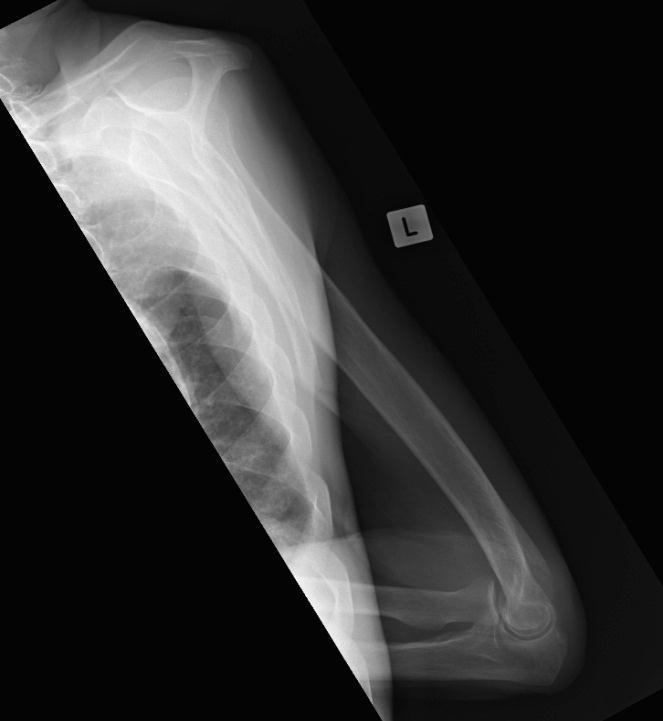 Twist collimators to run along humerus Centre Point: Mid humerus 1. Patient facing bucky 2.