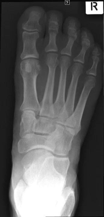 metatarsals Centre Point: Mid 3 rd metatarsal 1. Patient supine with knee flexed 2.