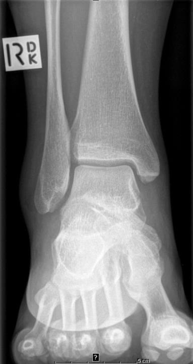 Foot flexed with plantar surface perpendicular to cassette 2.