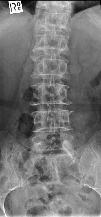 Reduce lateral borders to approximately 20cm wide Centre Point: 3cm above iliac crest, along axis of spine 1.