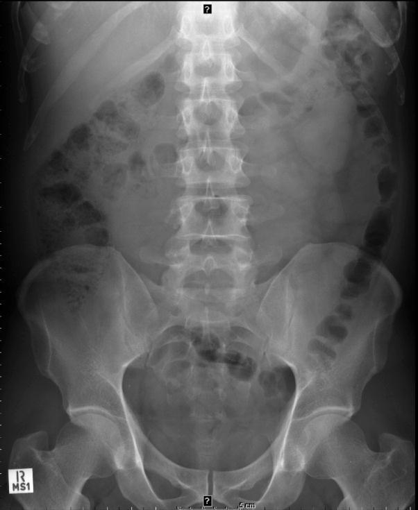 size. Do not increase collimation greater than film size. Centre Point: Iliac crest, along midline 1.