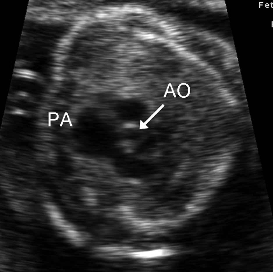 A, Enlarged pulmonary artery (PA) on the right ventricular outflow tract view. B, Three-vessel view.