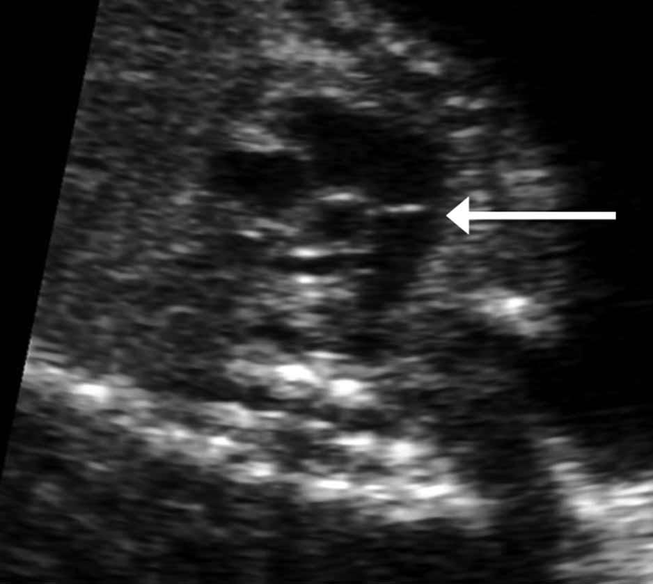 The valve leaflets should be thin and move freely. Second, poststenotic dilatation of the main pulmonary artery may be seen.
