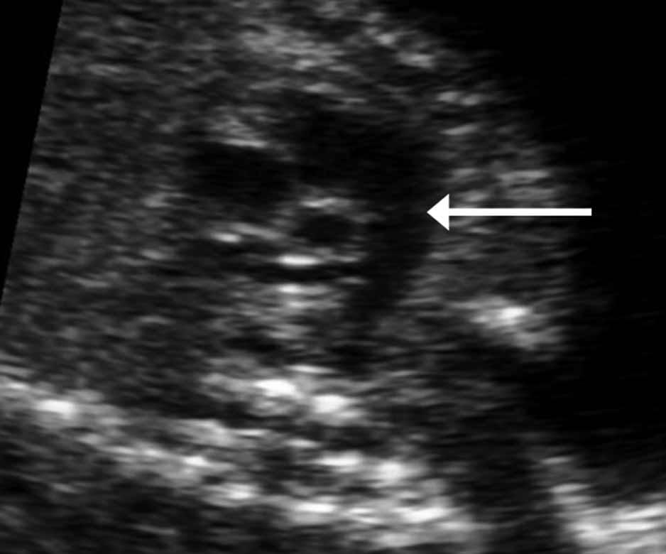 Normal appearance of the pulmonary value at 21 weeks gestation. A, Main pulmonary artery during systole showing an open pulmonary valve (arrow).