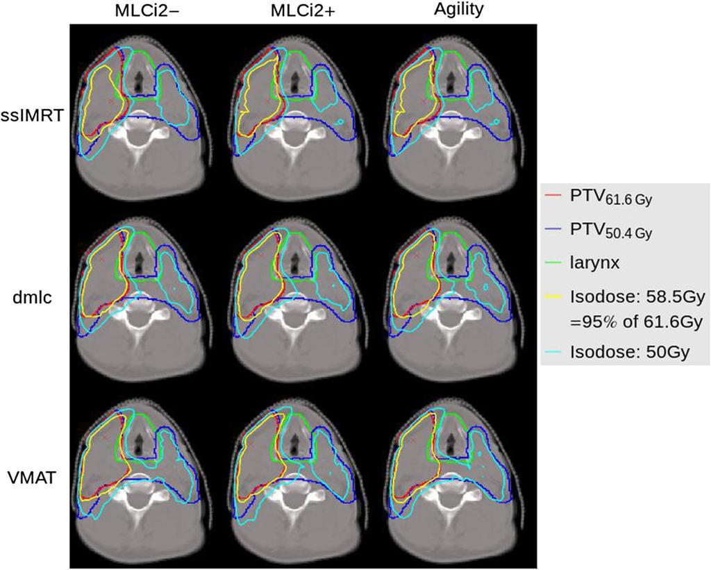 Kantz et al. Radiation Oncology (2015) 10:184 Page 8 of 15 Fig. 1 By example of patient case HN3, relevant isodoses for the larynx (50Gy, 58.
