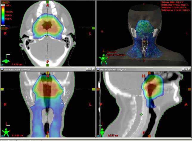 Benefits of IMRT Allows the simultaneous irradiation