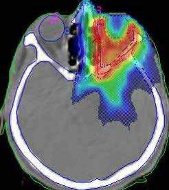 Intensity Modulated Radiation Therapy Generates
