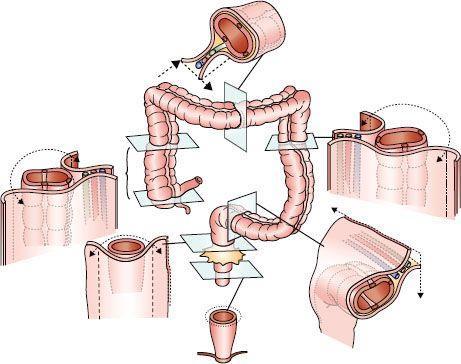 Peritoneal covering of the colo-rectum Transverse & sigmoid colon Intraperitoneal Complete serosal covering & a mesentery Ascending & descending colon Retroperitoneal No