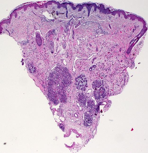 Rapidly involuting congenital hemangioma (RICH) Discreet hypercellular lobules with