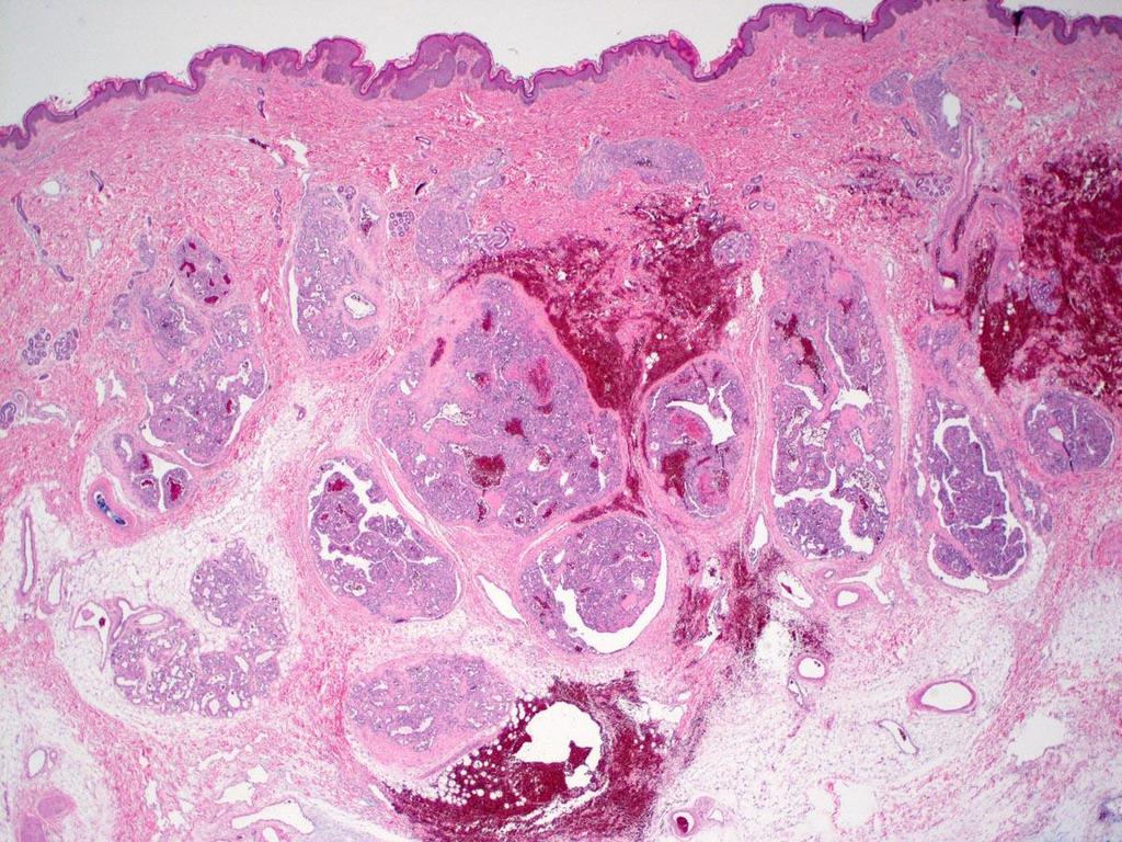 Fibrous tissue separating large lobules NICH Large lobules with