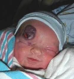 Congenital Hemangiomas (distinct from infantile hemangiomas) Fully formed at birth More common in males Can occur at any body site, commonly on head