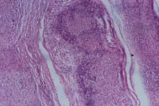 To compare the histopathology of skin and nerve in patients with single skin lesion Hansen s disease. 2. To assess the scientific rationale and justification of single dose ROM therapy.