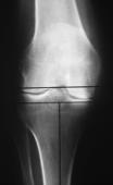 07/02/14 Femoral Component Alignment Surgeons have performed the distal femoral resec7on