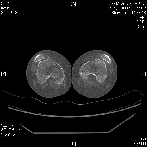 iden7ﬁca7on in trochlear dysplasia Tends to place the femoral component 4.4º 5.