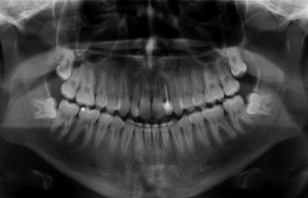 Immediate Post-OP Maxillary Occlusal photograph, right, of 16-year, four-month-old male following TAD placement and bonding of interim pontic for the congenitally missing maxillary left lateral