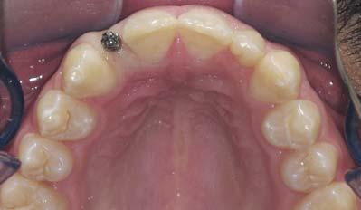 The nature of our retention protocol places our patients planned for restorable permanent implants in a very difficult position, asking them to expose their missing teeth while eating a very social