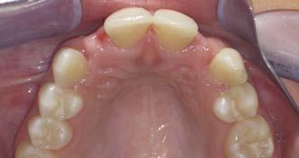 previously treated in retention phase with Maryland Bridge, which had multiple debonds seven months post treatment, in retention and completion of facial growth phase prior to endosseous implant