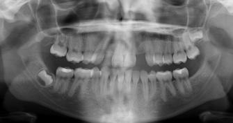 Maxillary occlusal photograph of 14-year, 10- month-old female in retention phase with Maryland Bridge removed prior to TAD placement.