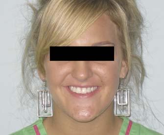 continued from page 26 Immediate post-operatory facial photograph of 14-year, 10-month-old female following TAD placement in the edentulous ridge space of the maxillary lateral incisors and following