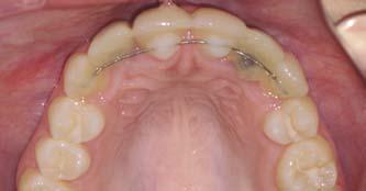 Immediate post-op radiograph of 14-year, 10- month-old female following TAD placement in the edentulous ridge space of the maxillary lateral incisors and following bonding of the pontic teeth.