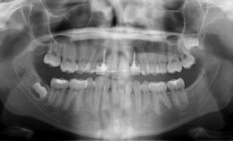 Any type of fixed permanent retainer is acceptable, but the permanent retainer should adapt to the lingual surface of the pontic teeth but not be bonded to the pontic.