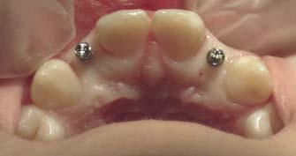 clinical orthodontics There have also been suggestions that TAD placement in edentulous spaces maintains vertical bone height.