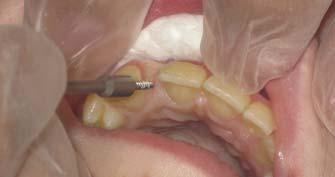 devices should lead the clinical orthodontist to be cautious in treatment planning this therapy expecting bone preservation.