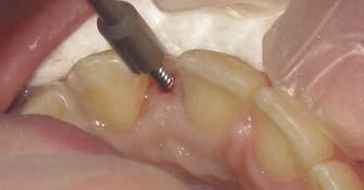 It is also important to consider that the majority of patients with congenitally missing anterior teeth will require vertical and buccal bone grafts in addition to endosseous implant placement, and