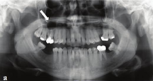 2 Case Reports in Dentistry (a) (a) (b) (c) (b) (c) (d) Figure 1: Panoramic radiograph showing well-defined periapical radiolucency in
