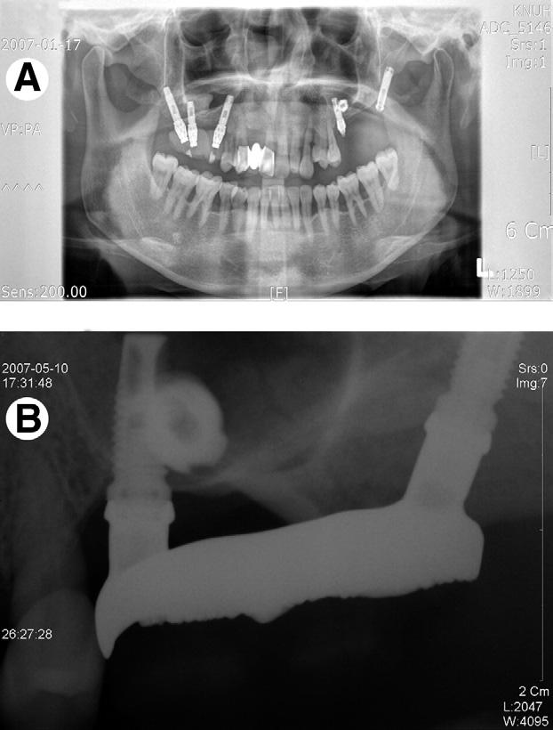 1340 TUBEROSITY BONE FIXTURE SURVIVAL MEASUREMENT OF MOBILITY OF FIXTURE The mobility of all tuberosity implants except that in patient 5, who had a commentated fixed bridge with a natural second