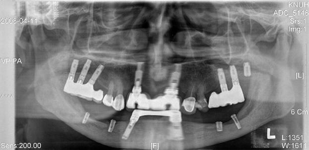 The anterior bridge was removed for screw-loosening check. FIGURE 5.
