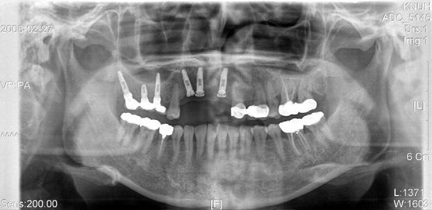 fixed bridge. B, After splinting with the ceramometal fixed bridge, which was connected to a natural tooth, 3 years 9 months later, only the first screw level of marginal bone loss (0.