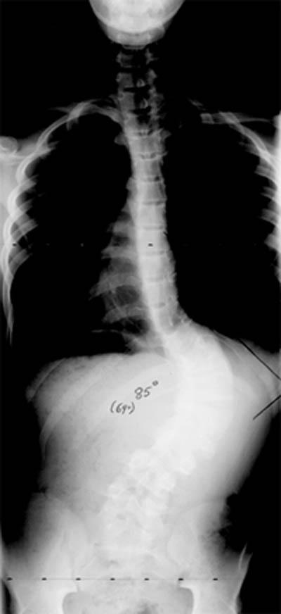 Pediatric Congenital Scoliosis Malformation of spinal segments Idiopathic Adult Infantile (<3 years of age) Juvenile