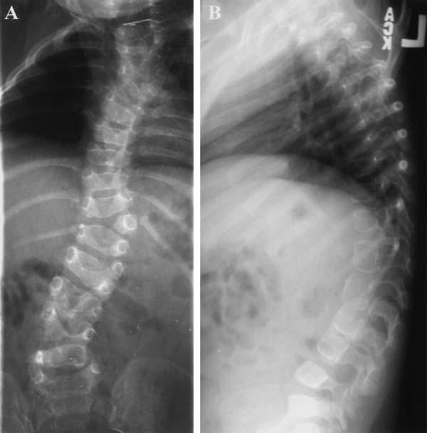 Congenital Scoliosis Abnormal development of the spine resulting in: