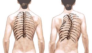 Pediatric Idiopathic Scoliosis Idiopathic Infantile/congenital (<3 years of age) More boys than girls 80% resolve