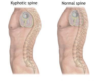 Kyphosis A spine affected by kyphosis shows evidence of a forward curvature of the